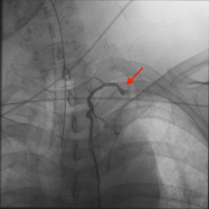 Near complete occlusion of distal TD